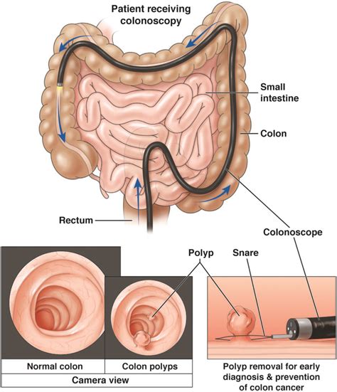 Colonoscopy - AGA GI Patient Center