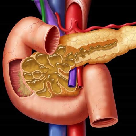 Pancreatic IPMN | Clinical Gate