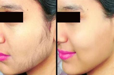 Hirsutism in Women - Dr. Walia's Skin And Laser Clinic