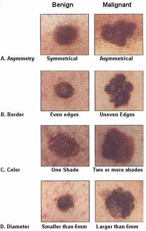 Cancerous Mole Vs Normal Mole