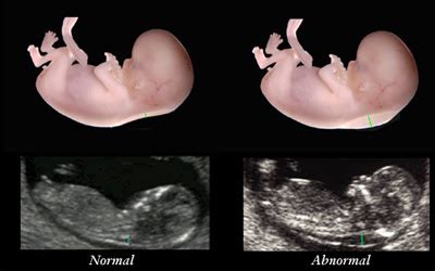 alo's place: Nuchal Translucency Test