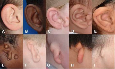 Photographs of individuals with different types of microtia. A: typical... | Download Scientific ...