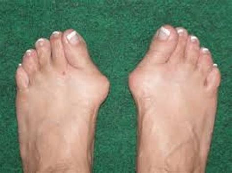 A Bunion; Its Causes, Symptoms, And Treatment - 9jastreet.com