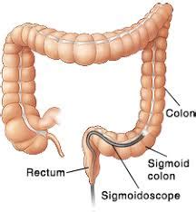 Flexible Sigmoidoscopy