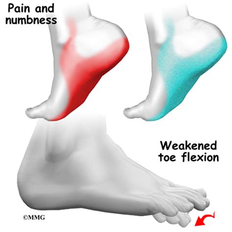 Tarsal Tunnel Syndrome - eOrthopod.com