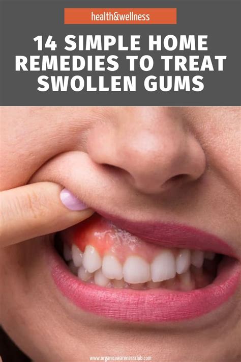 14 Simple Home Remedies To Treat Swollen Gums | Swollen gums remedy, Sore gums remedy, Swollen gum