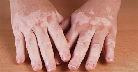 Dyschromia, dyspigmentation present unique challenges for skin of color