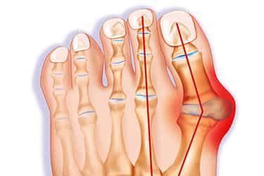 Bunions - What is a bunion? Signs, Symptoms and Treatment | Nuffield Health