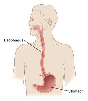 Esophageal Ulcer | Saint Luke's Health System