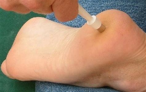 Skin biopsy - Wikiwand