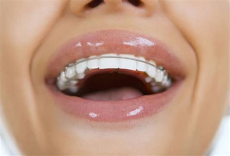 Types Of Removable Orthodontic Retainers at Crystal Gilbert blog