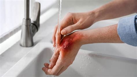 First aid for skin: How to treat cuts, burns and fungal infections ...