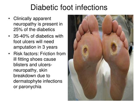 PPT - Infections in diabetes PowerPoint Presentation, free download - ID:3762927