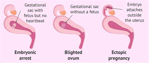 Miscarriage types according to gestational sac