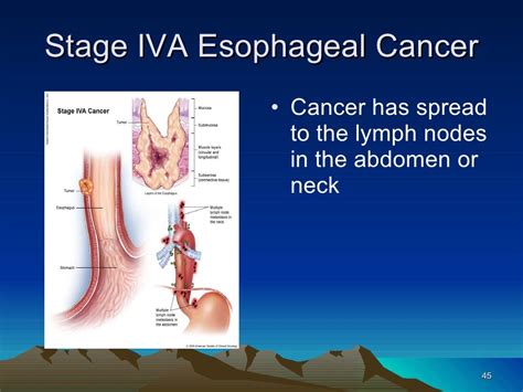 11 esophageal cancer