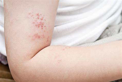 The Discomfort of Shingles - Twin Rivers Health Care