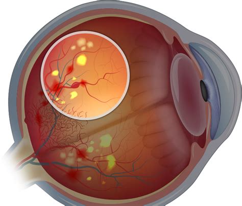 Diabetic Retinopathy Surgery