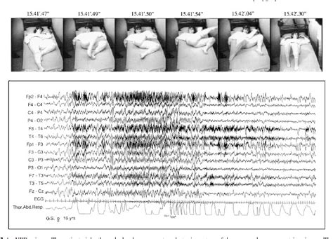 Figure 2 from Nocturnal frontal lobe epilepsy. A clinical and ...