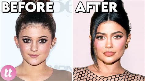 Celebrities Before And After Plastic Surgery