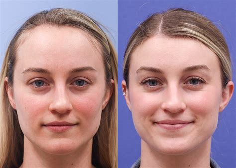 Forehead Reduction Before and After 05