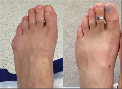 Tailors Bunion Surgery Before And After