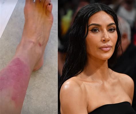 Kim Kardashian Opens Up About Painful Psoriasis Flare-Up and Treatment ...