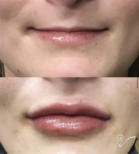 1 Syringe Of Juvederm In Lips Before And After | Lipstutorial.org