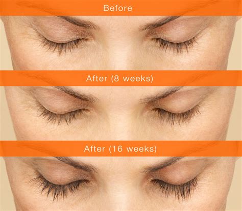 My patient coordinator's experience trying Latisse for eyelash growth — Lara Devgan, MD, MPH, FACS