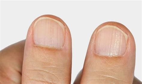 The 5 signs in your nails you have a vitamin deficiency - from white ...