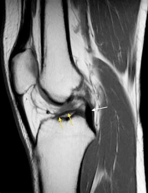 Diagnosis of ACL Tear or Injury - PT Master Guide