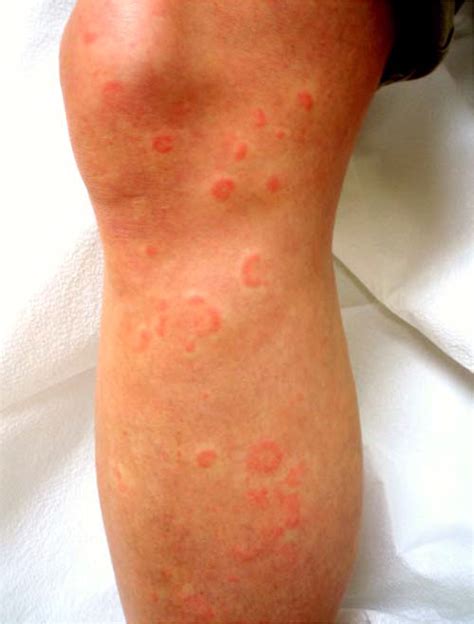 Pityriasis Rosea With Erythema Multiforme Like Lesion - vrogue.co