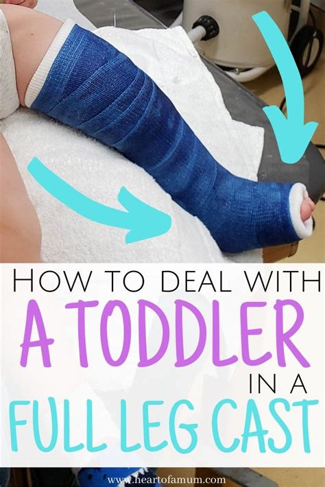 How to survive a toddler with a broken leg | Leg cast, Baby cast, Kids cast