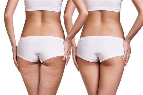 Cellulite/Skin Tightening Treatment - Apex Medical Spa