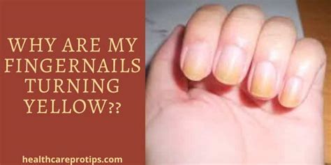 Why Are My Fingernails Turning Yellow? Causes and Treatments