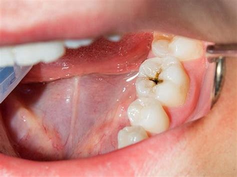 What is tooth decay and cavity? Home remedies to cure it naturally at home | Chandigarh Ayurved ...