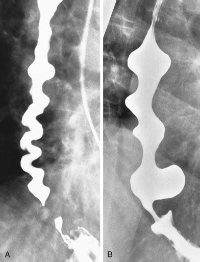 Motility Disorders of the Esophagus | Radiology Key