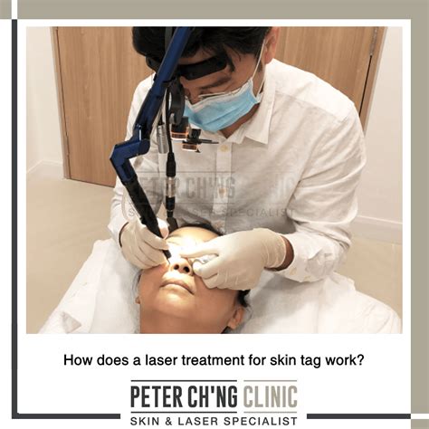 Patient Mailbox: Can I Remove Skin Tags on My Own? | Peter Ch'ng Skin Specialist - KL, Malaysia