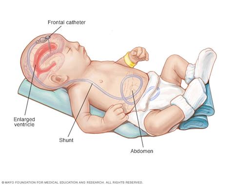 Shunt system - Mayo Clinic