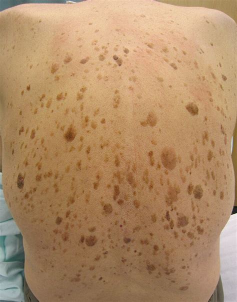 Seborrheic keratosis - Libre Pathology