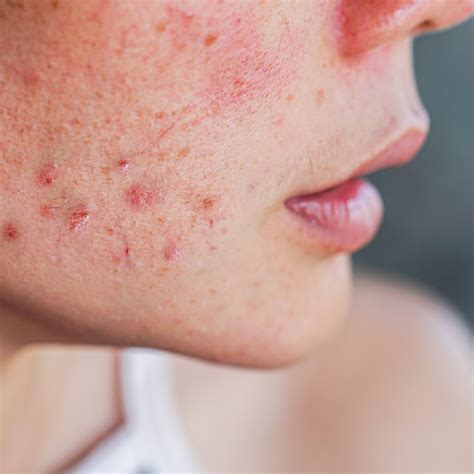 Hormonal Acne: Causes, Symptoms, and Targeted Treatments - Freyja Medical