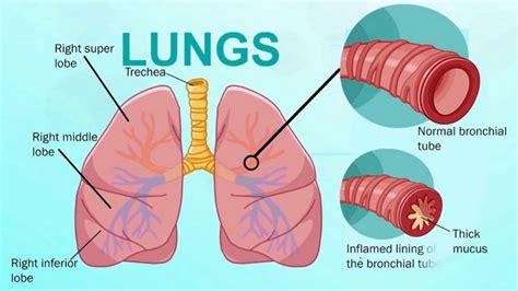 Inflamed Bronchial Tubes