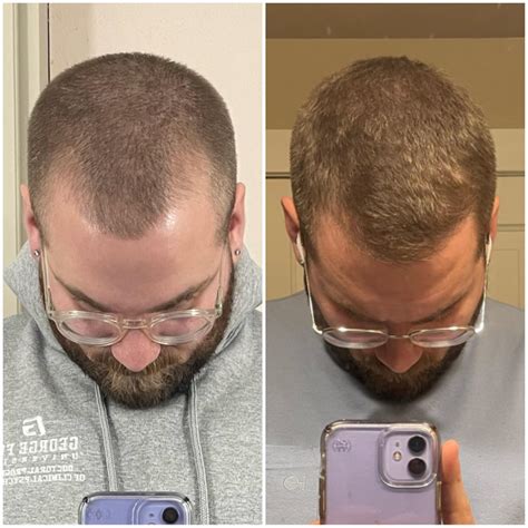 9 months on Hims minoxidil & finasteride spray. Happy with the results! : r/tressless