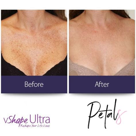 V Shape Results - Before and After - Petals Laser Lounge NYC Laser Spa | V shape, Face ...