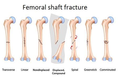 Femur - Physiopedia