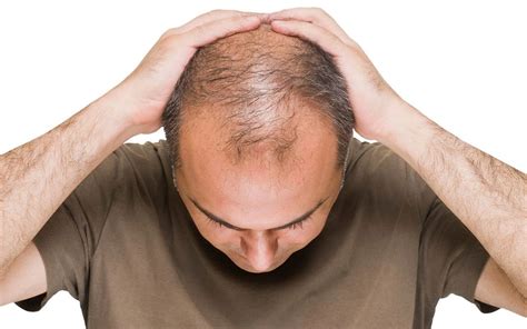 Androgenic Alopecia