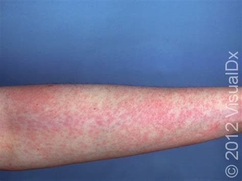 Rubella (German Measles): Symptoms, Treatment, and Prevention