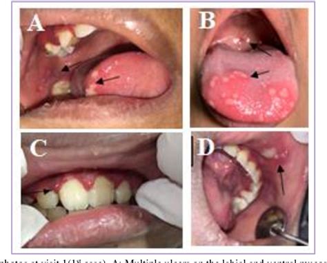 Figure 1 from Management of Primary Herpetic Gingivostomatitis in Children: Case Report ...