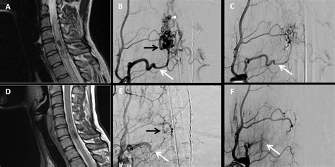 Long term follow-up of endovascular management of spinal cord arteriovenous malformations with ...