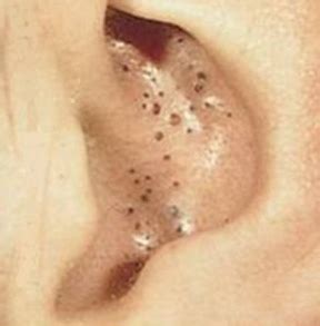 blackheads in ear picture What Causes Blackheads, Blackheads On Cheeks, Get Rid Of Blackheads ...