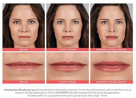 JUVEDERM® Ultra XC - Jefrey Fishman | Troy 248-643-7374 | Novi 248-643-7374